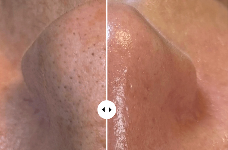 Hydrafacial